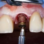 İmplant sonrası ağrı ve hassasiyetin diş eti, implant çevresi ve kapanış açısından değerlendirildiği klinik muayene.