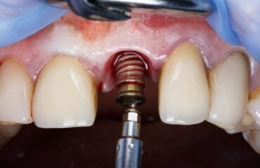 İmplant sonrası ağrı ve hassasiyetin diş eti, implant çevresi ve kapanış açısından değerlendirildiği klinik muayene.