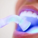 Kompozit bonding ve porselen lamina veneer restorasyonlarının diş yüzeyindeki yapısal farklılıklarını gösteren dental çizim.