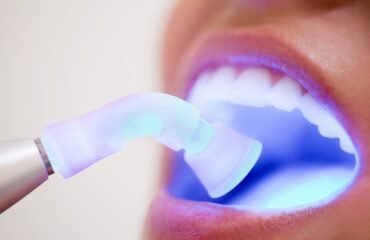 Kompozit bonding ve porselen lamina veneer restorasyonlarının diş yüzeyindeki yapısal farklılıklarını gösteren dental çizim.