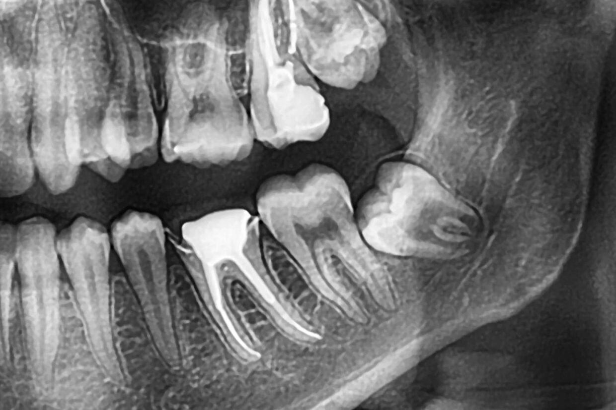 20 yaş dişi çekimi sonrası alveolit gelişen çekim boşluğunun ve iyileşme sürecinin dental değerlendirmesi.