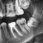 20 yaş dişi çekimi sonrası alveolit gelişen çekim boşluğunun ve iyileşme sürecinin dental değerlendirmesi.