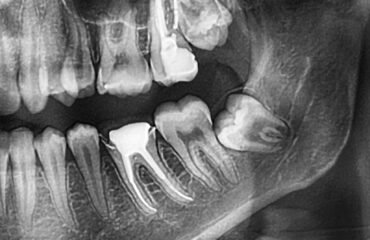 20 yaş dişi çekimi sonrası alveolit gelişen çekim boşluğunun ve iyileşme sürecinin dental değerlendirmesi.