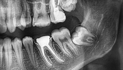 20 yaş dişi çekimi sonrası alveolit gelişen çekim boşluğunun ve iyileşme sürecinin dental değerlendirmesi.