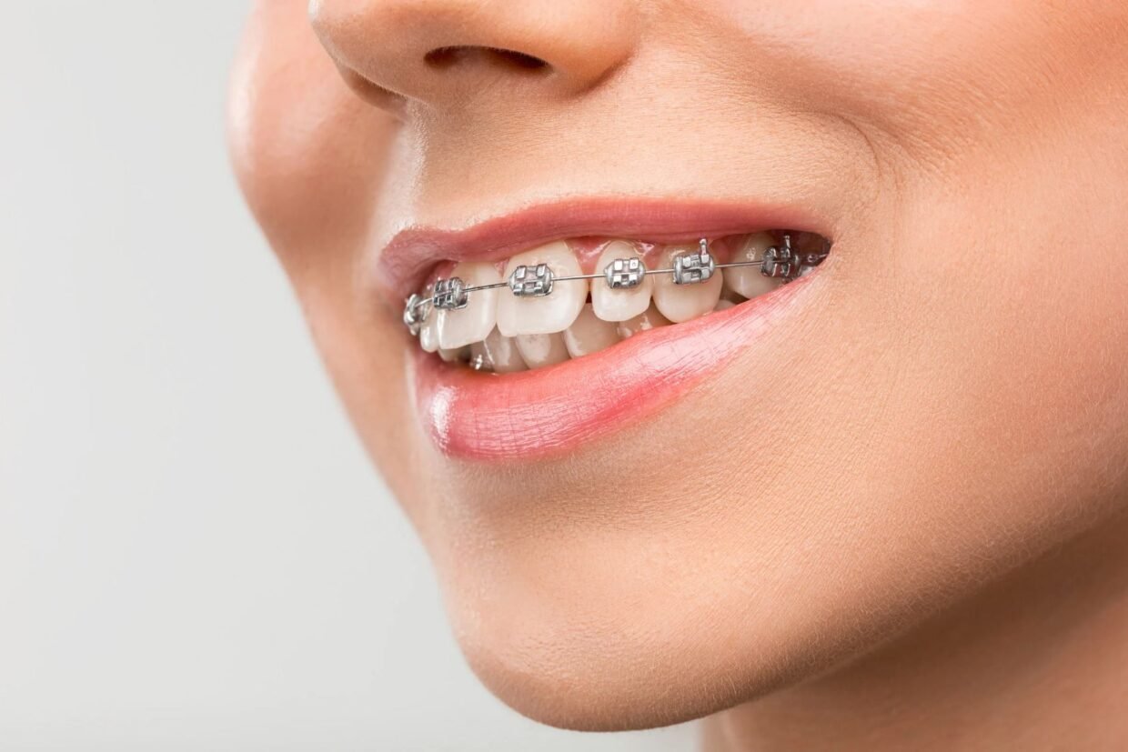 Diş teli tedavisinde braketler, ortodontik teller ve dişlerin aşamalı hareketini gösteren bilgilendirici dental görsel.
