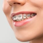 Diş teli tedavisinde braketler, ortodontik teller ve dişlerin aşamalı hareketini gösteren bilgilendirici dental görsel.