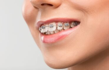 Diş teli tedavisinde braketler, ortodontik teller ve dişlerin aşamalı hareketini gösteren bilgilendirici dental görsel.