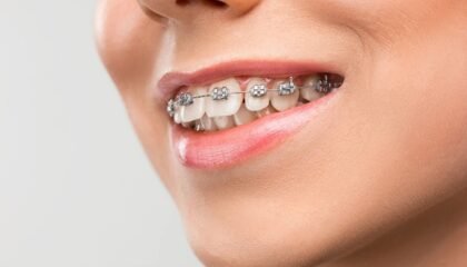 Diş teli tedavisinde braketler, ortodontik teller ve dişlerin aşamalı hareketini gösteren bilgilendirici dental görsel.