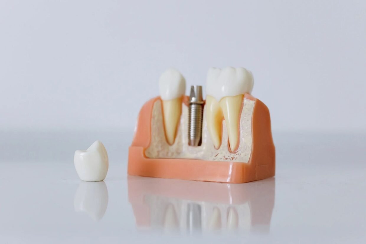 Diş implantının çene kemiğine yerleştirilmesi, osseointegrasyon ve implant üstü protez aşamalarını gösteren dental çizim.