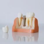 Diş implantının çene kemiğine yerleştirilmesi, osseointegrasyon ve implant üstü protez aşamalarını gösteren dental çizim.