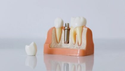 Diş implantının çene kemiğine yerleştirilmesi, osseointegrasyon ve implant üstü protez aşamalarını gösteren dental çizim.